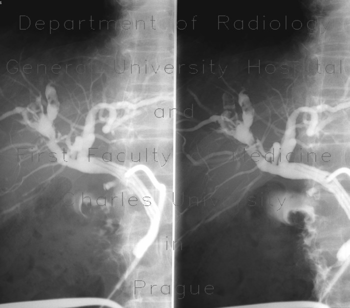 Cholangiography, hepaticolithiasis