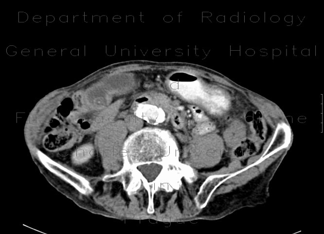 Cholecystolithiasis