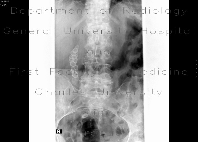 Cholecystolithiasis, gall stones