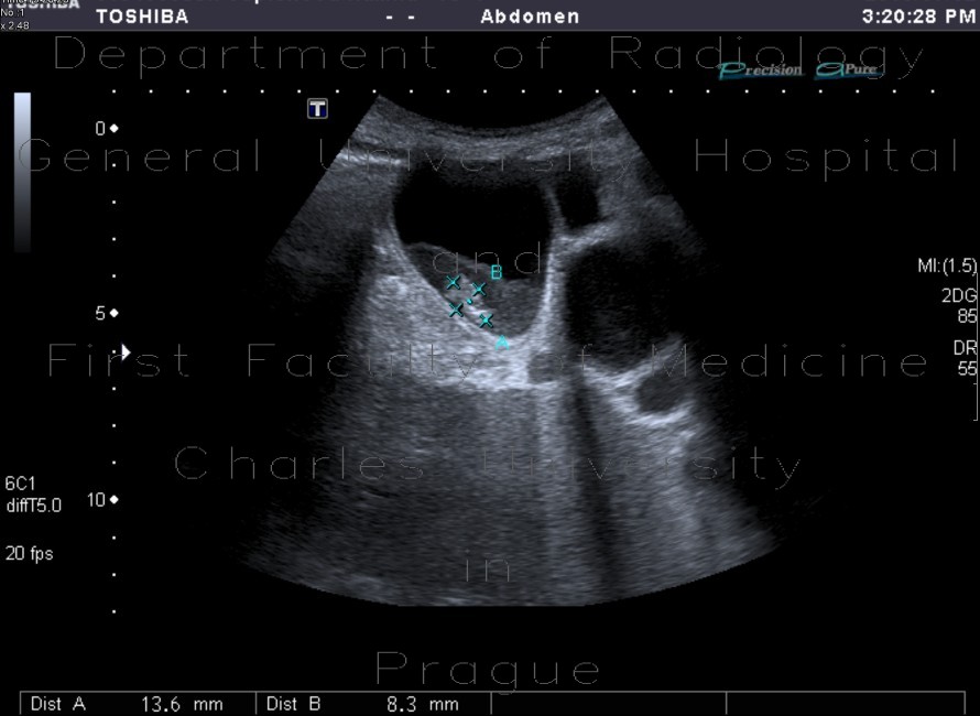 Cholecystolithiasis with sludge