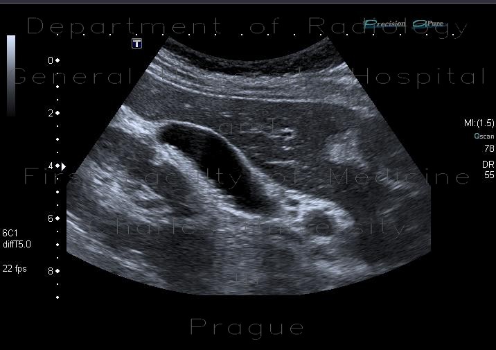 Cholecystolithisasis, gallstones