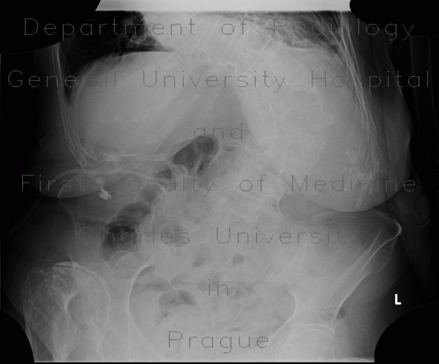 Radiology image - Cholecystostomy, acute cholecystitis: Abdomen, Biliary tree, Other: X-ray - Plain radiograph