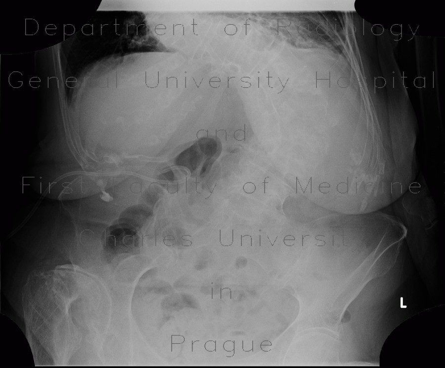 cholecystitis x ray