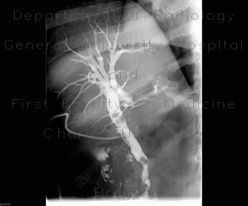 Radiology image - Choledocholithiasis, T-drain: Abdomen, Biliary tree: RF - Fluoroscopy