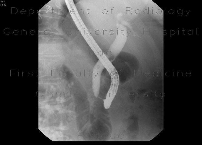 Radiology image - Choledocholithiasis, bile duct stones, ERCP: Abdomen, Biliary tree: RF - Fluoroscopy