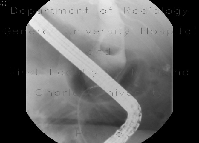 Radiology image - Choledocholithiasis, biliary duct stone, ERCP: Abdomen, Biliary tree: RF - Fluoroscopy