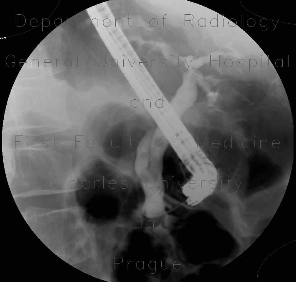 Choledocholithiasis, cholecystolithiasis, gallstones, biliary obstruction, ERCP