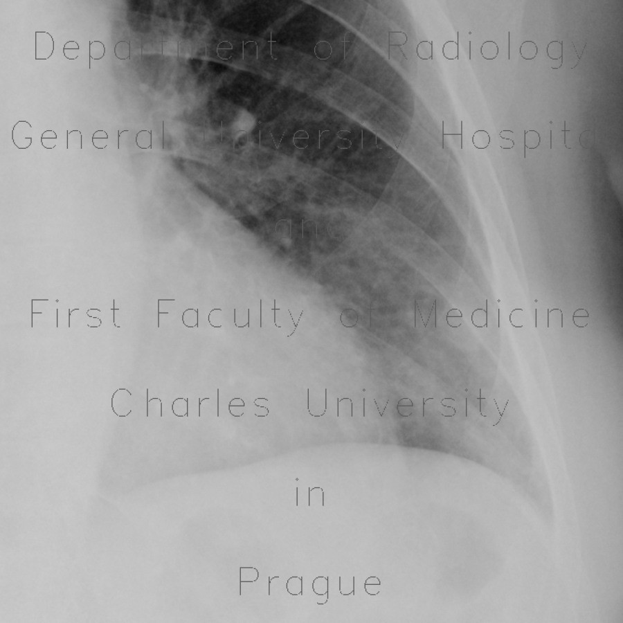 Chondrohamartoma of lung, ground-glass