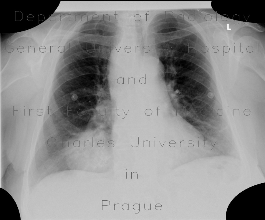 Radiology image - Chondroma of lung, gigantic: Thorax, Lung: X-ray - Plain radiograph