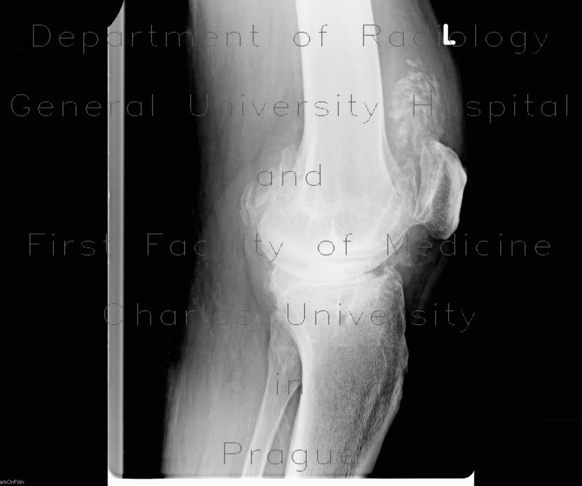 Chondromatosis, gonarthrosis