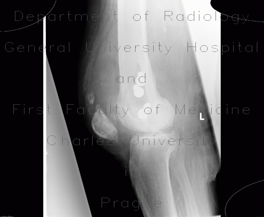 Chondromatosis of knee joint, effusion, fracture of femur, osteosynthesis