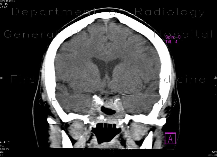 Radiology image - Chordoma: Brain, Brain: CT - Computed tomography