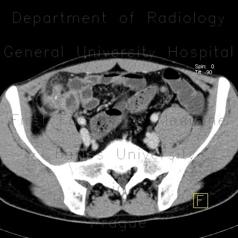 Radiology image - Chronic appendicitis, mimic of Crohn
