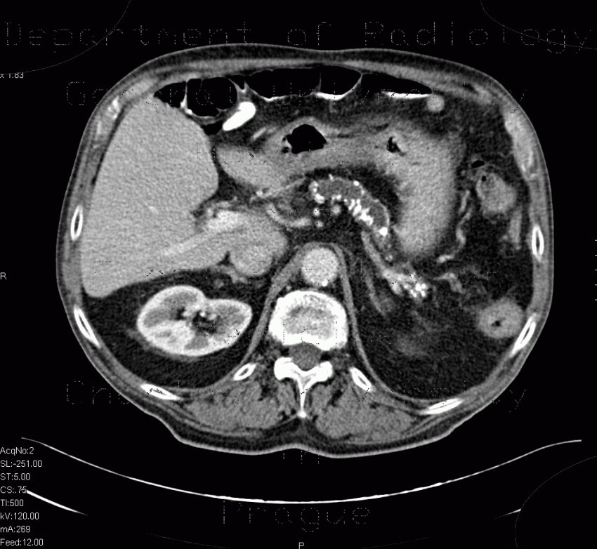 Radiology image - Chronic calcified pancreatitis: Abdomen, Pancreas: CT - Computed tomography