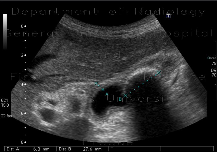 Chronic cholecystitis, cholecystolithiasis