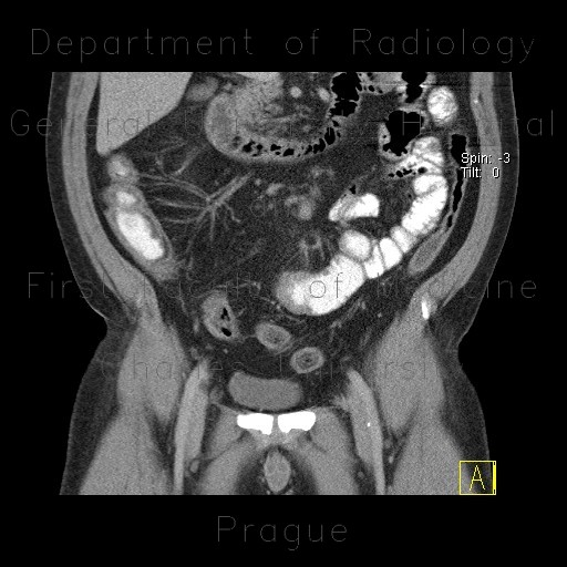 Chronic inflammatory changes of aboral ileum and cecum, fatty infiltration of bowel wall