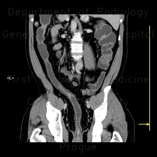 Radiology image - Chronic inflammatory changes of descendent and sigmoid colon: Abdomen, Large bowel: CT - Computed tomography