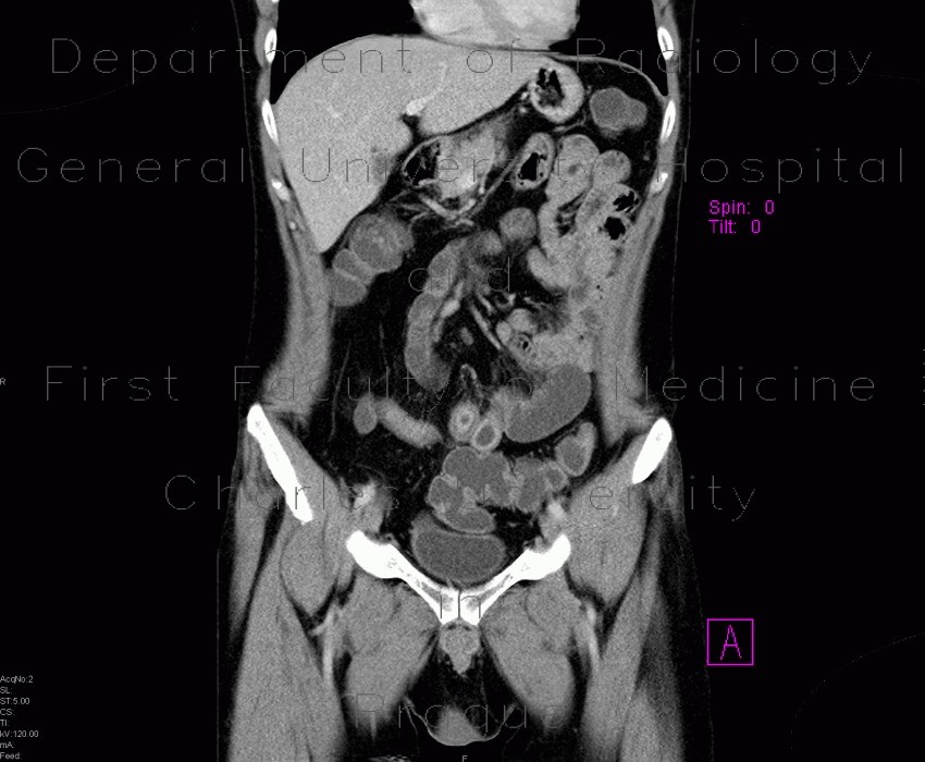 Chronic inflammatory changes of terminal ileum and rectum, pelvic lipomatosis