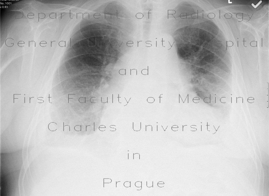 Radiology image - Chronic lung congestion, Kerley B lines, pleural effusion, aortomitral valvular disease: Thorax, Heart, Lung: X-ray - Plain radiograph