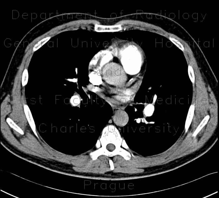 Chronic lung embolism