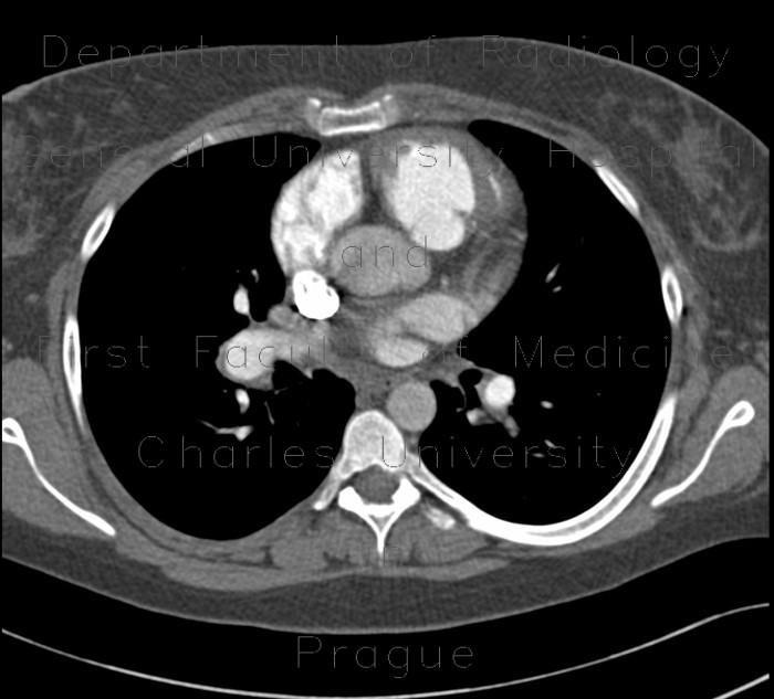 Chronic lung embolism, pulmonary hypertension, webs, adherent thrombi