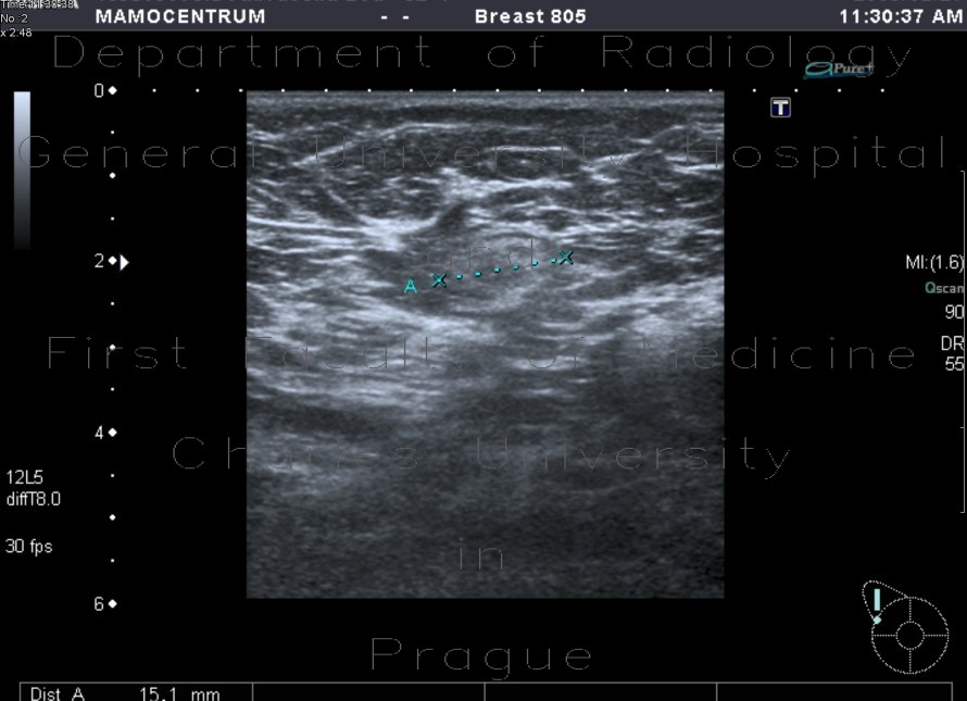 Chronic lymph node