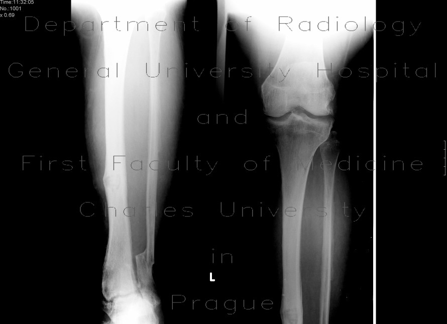 Chronic osteomyelitis and bone squestration