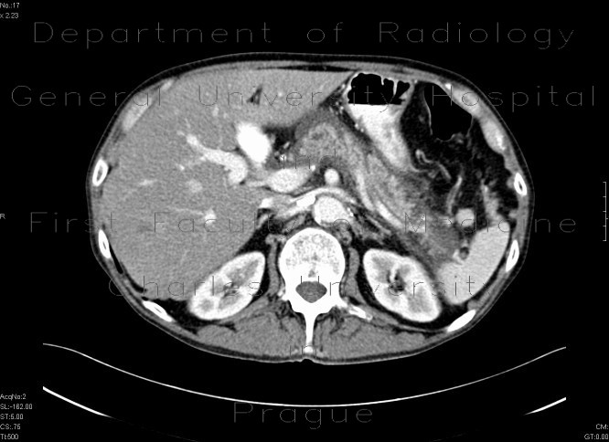 Radiology image - Chronic pancreatitis - acute exacerbation: Abdomen, Pancreas: CT - Computed tomography