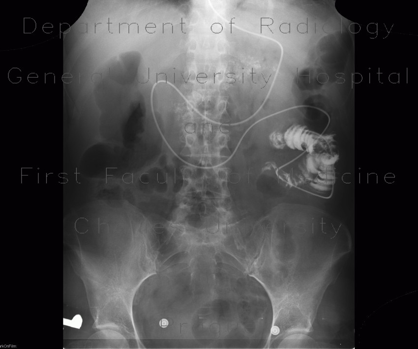 Radiology image - Chronic pancreatitis, calcified, nasojejunal tube: Abdomen, Pancreas: X-ray - Plain radiograph