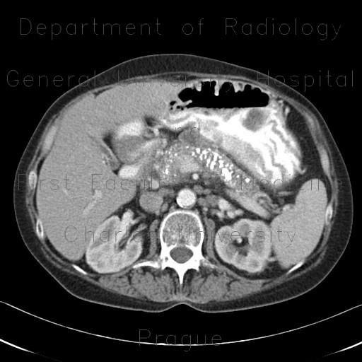 Radiology image - Chronic pancreatitis, calcified pancreatitis: Abdomen, Pancreas: CT - Computed tomography