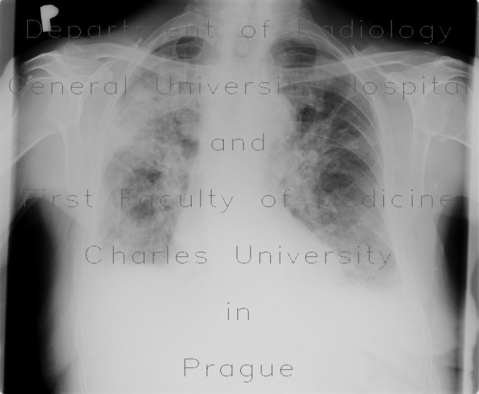 Chronic postinflammatory changes, pachypleuritis, pleural effusion, traction bronchiectasia