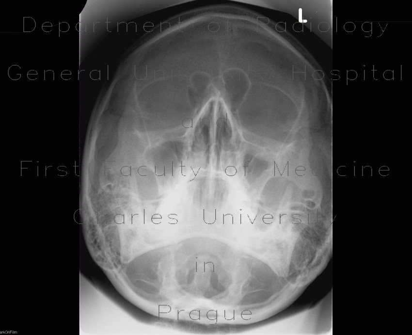 Chronic sinusitis, Waters view