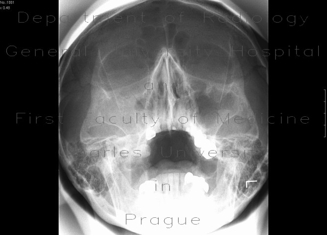 Chronic sinusitis, foreign body