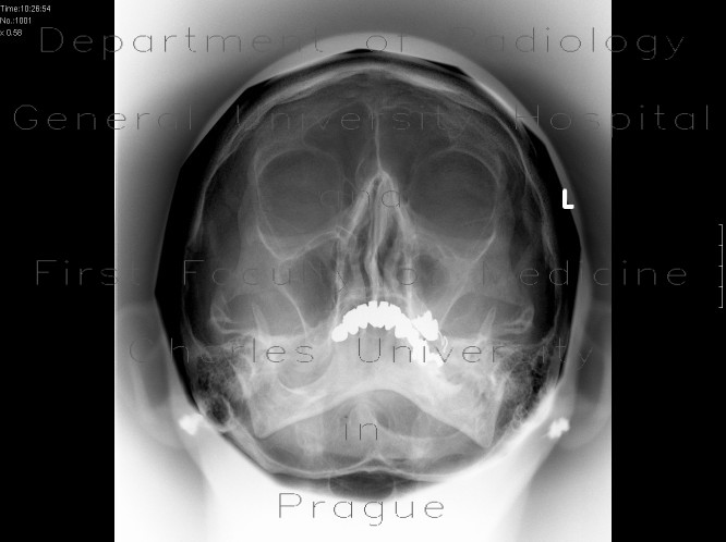 Radiology image - Chronic sinusitis, maxillary sinus, left side: Head and Neck, Sinuses: X-ray - Plain radiograph