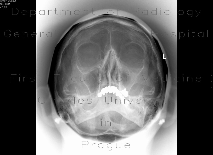Radiology image - Chronic sinusitis of the left maxillary sinus: Head and Neck, Sinuses: X-ray - Plain radiograph