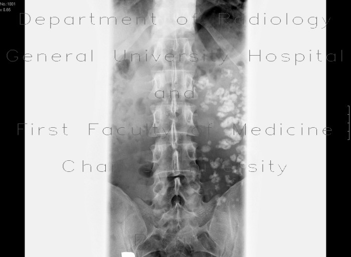 Radiology image - Chyme in bowel loops: Abdomen, Large bowel, Small bowel: X-ray - Plain radiograph