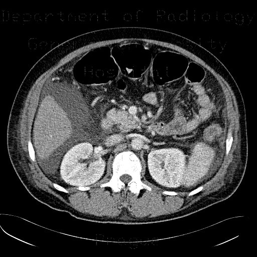 Circumarotic left renal vein
