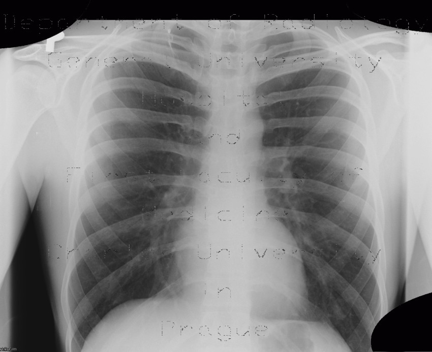 Clip in the lung parenchyma after resection of bulla