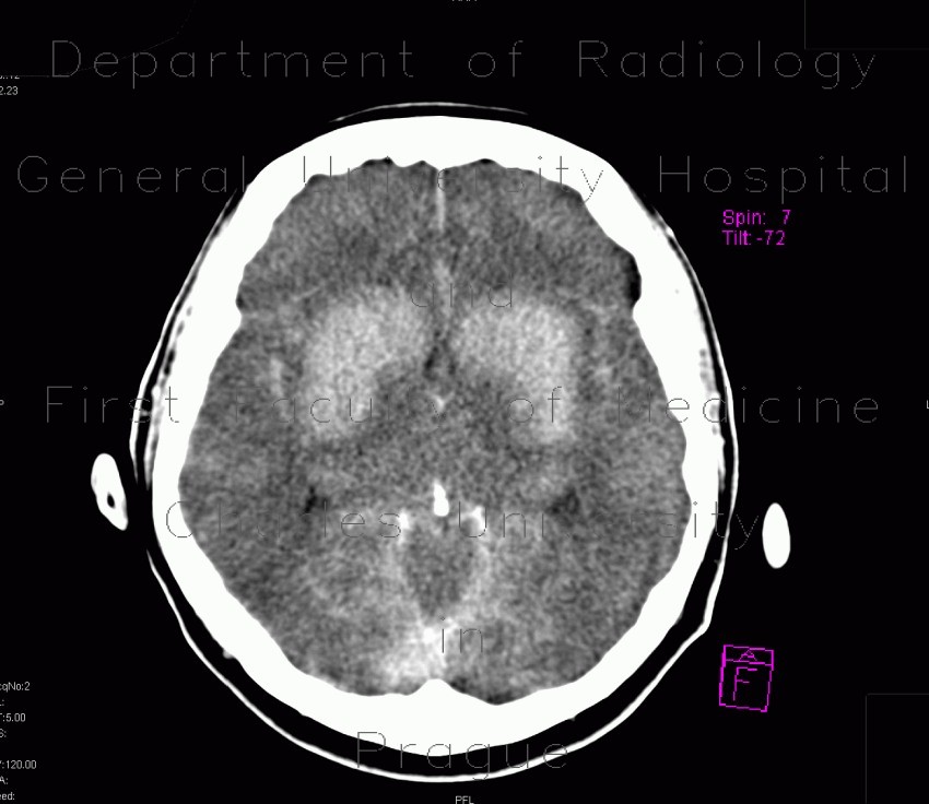 Radiology image - Coagulation necrosis of basal ganglia: Brain, Brain: CT - Computed tomography