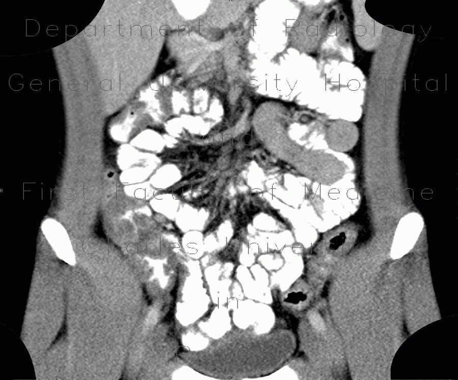 Colitis, ileitis, inflammation of terminal ileum and large bowel