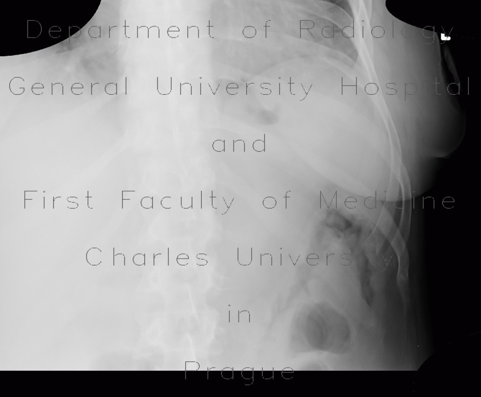 Radiology image - Colitis, thumbprinting: Abdomen, Large bowel: X-ray - Plain radiograph