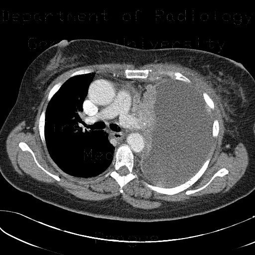 Collapse of lung wing, central tumour