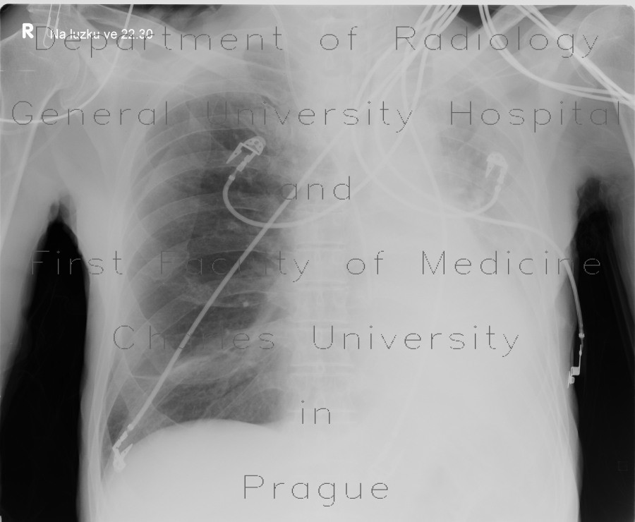 Collapse of pulmonary lobe, left lower lung lobe, LLL