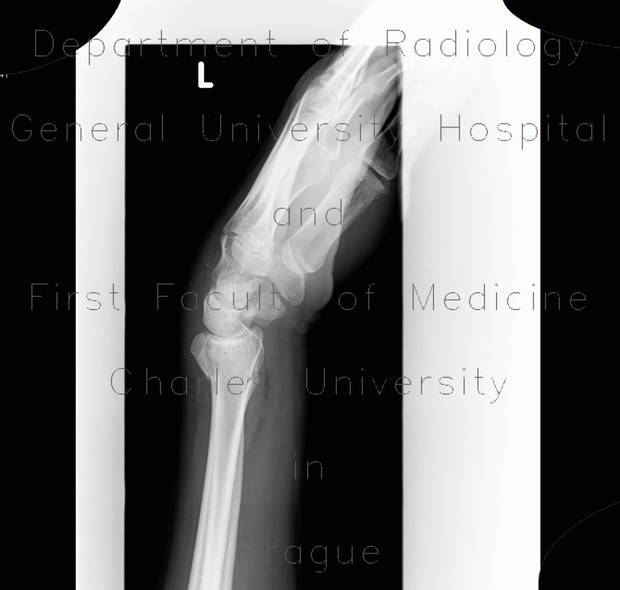 Colles fracture, pronator quadratus, fat pad sign