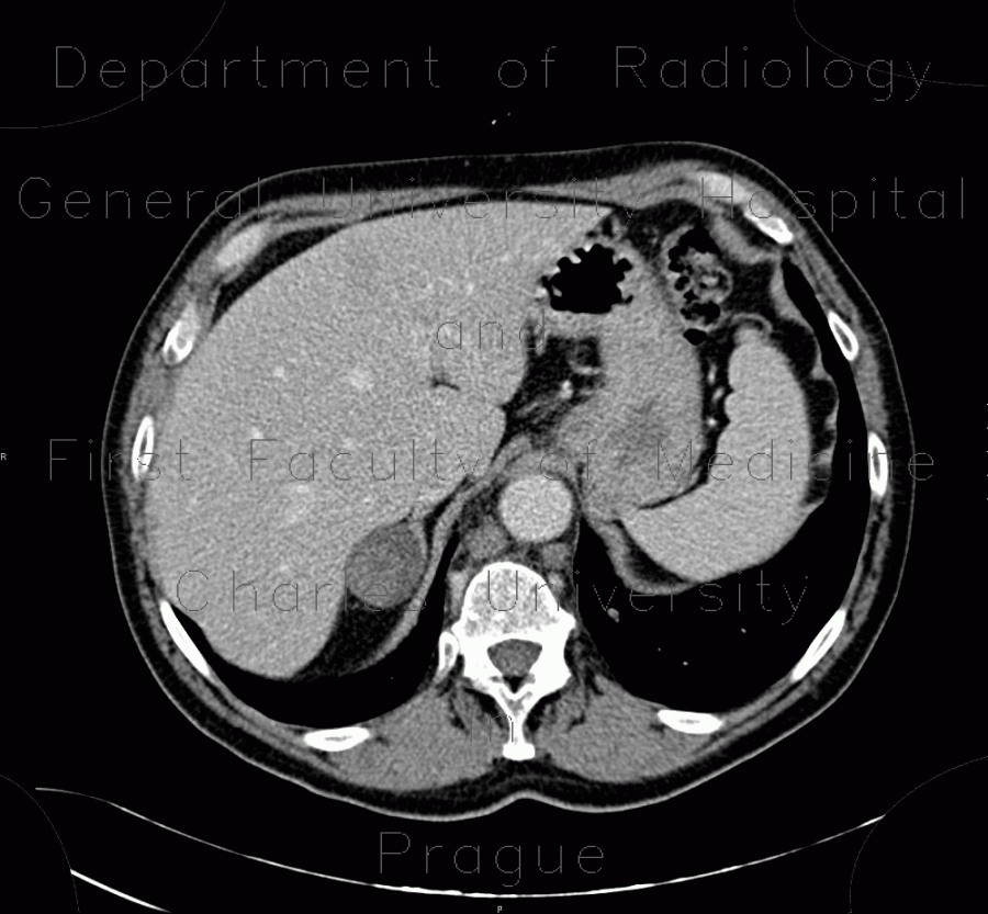 Radiology image - Collision tumour, adrenal adenoma, metastasis: Abdomen, Kidney and adrenals: CT - Computed tomography