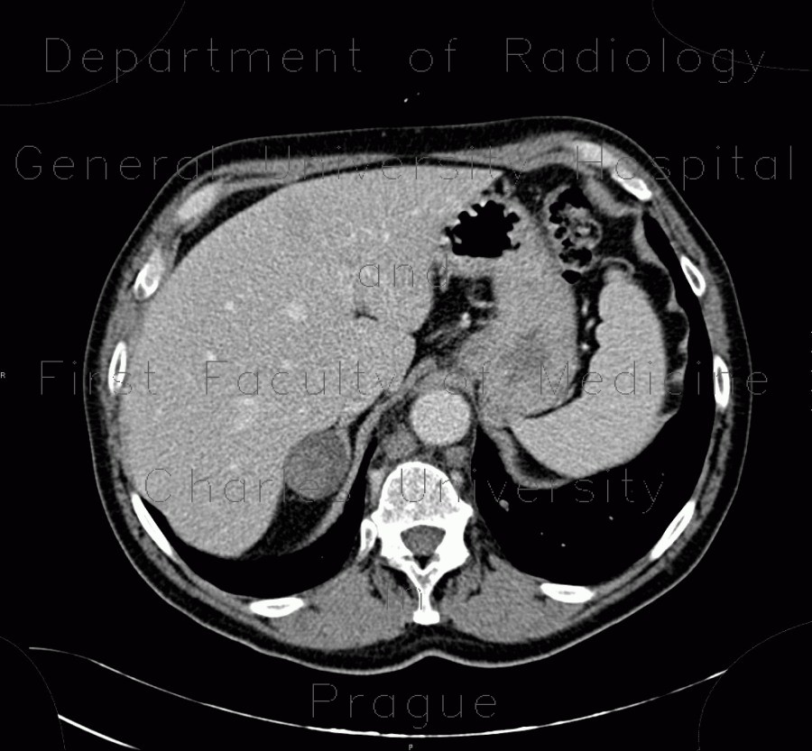 Collision tumour, adrenal adenoma, metastasis