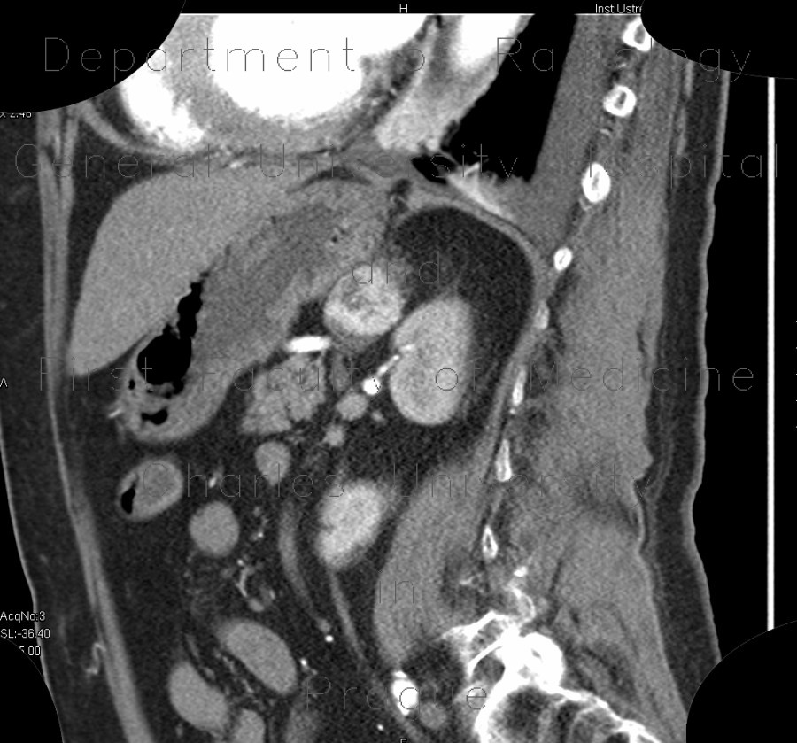 Collision tumour, adrenal gland, myelolipoma, metastasis