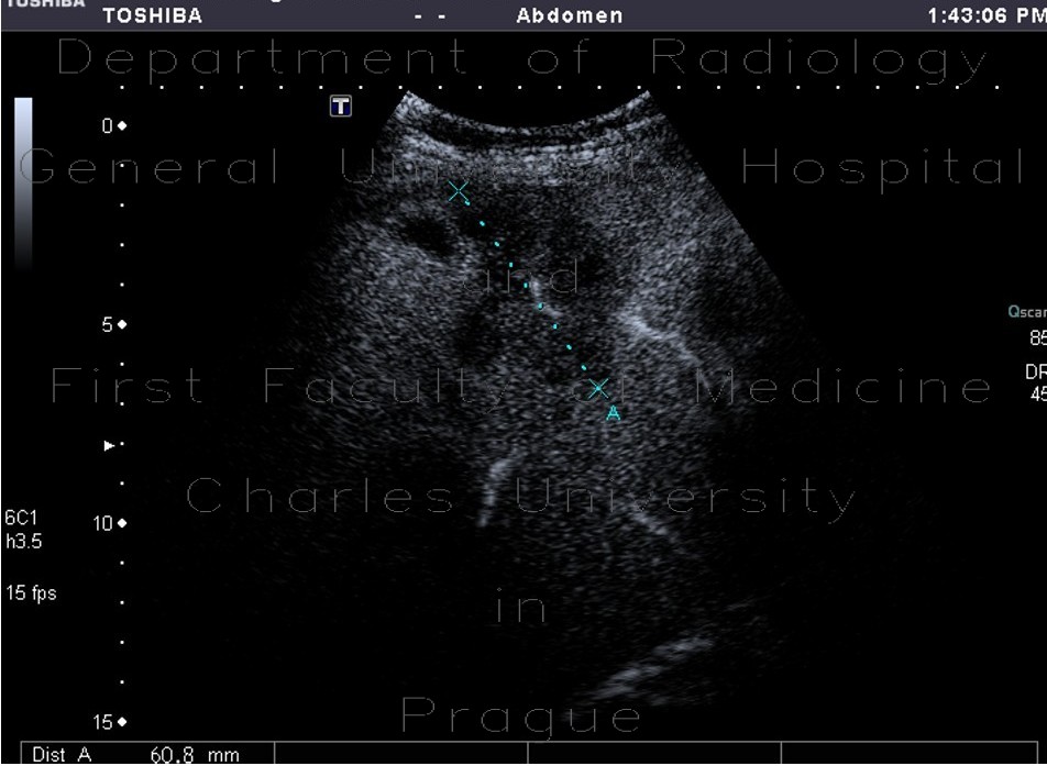 Radiology image - Colon metastases in the liver, CEUS: Abdomen, Liver: US - Ultrasound