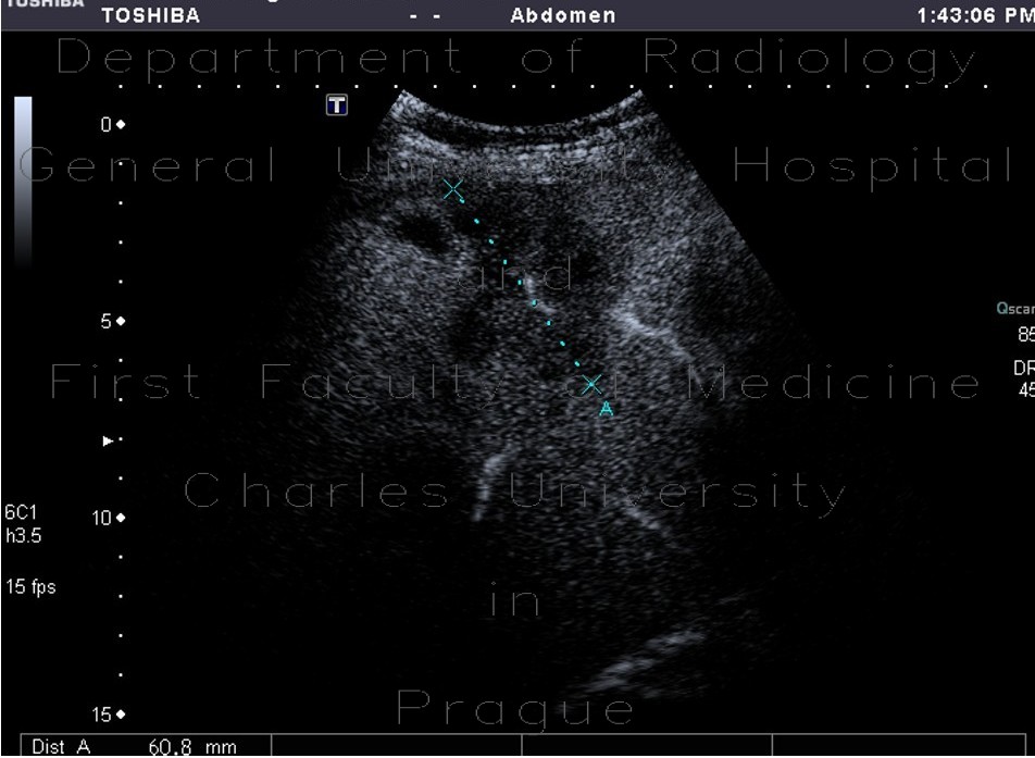 Colon metastases in the liver, CEUS