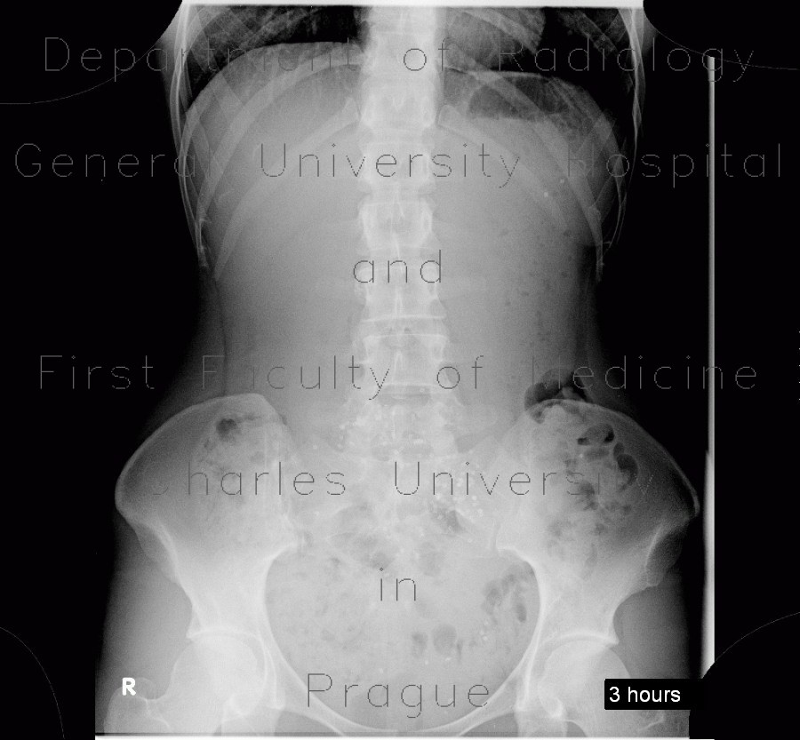 Radiology image - Colonic transit time, delayed: Abdomen, Large bowel: RF - Fluoroscopy